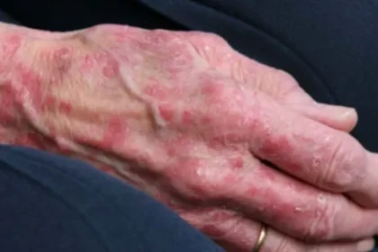 Romanya ve Hırvatistan'da cüzzam vakaları görüldü. 40 yıl sonra ilk