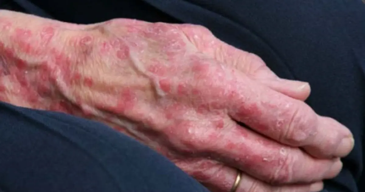 Romanya ve Hırvatistan'da cüzzam vakaları görüldü. 40 yıl sonra ilk