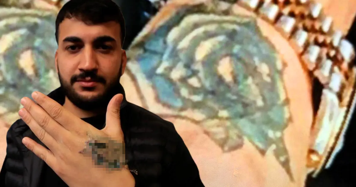 Dövmesini sildirmek istedi, elinden oluyordu | NTV Haber